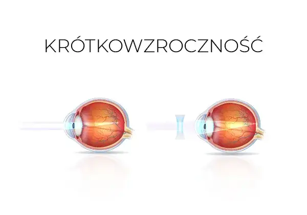 Wady wzroku i jak je korygować - poznaj skuteczne metody poprawy widzenia