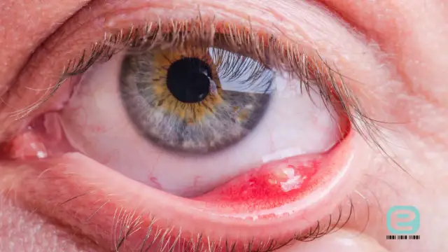 Jęczmień na oku: Jak leczyć w domu i kiedy iść do lekarza?
