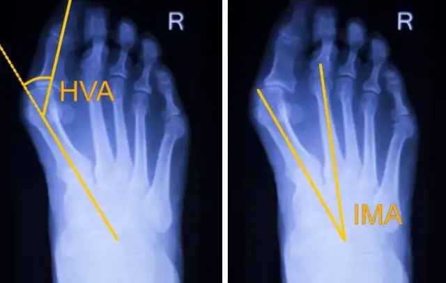 Haluks: Operacja krok po kroku. Co musisz wiedzieć przed zabiegiem?