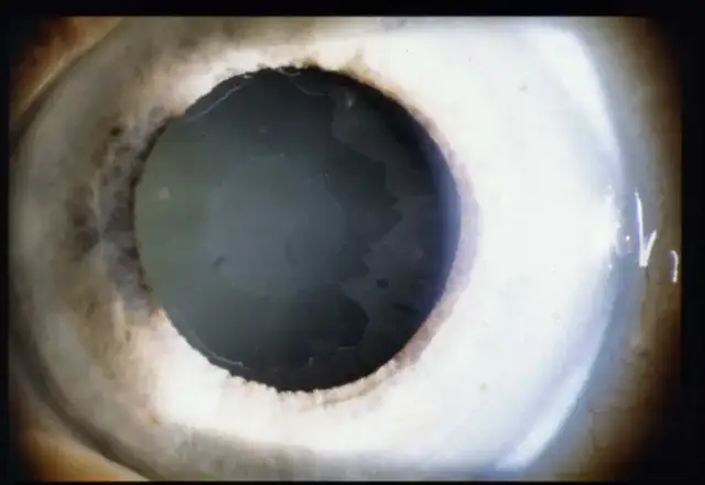 Jakie są objawy jaskry barwnikowej i jak je rozpoznać?