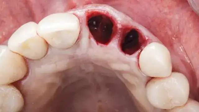 Czym smarować dziąsło po wyrwaniu zęba, aby uniknąć bólu?