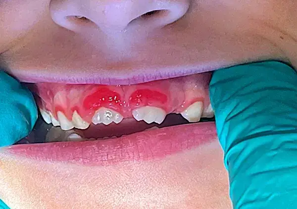 Zapalenie dziąseł u dziecka: Objawy, leczenie, kiedy do dentysty?