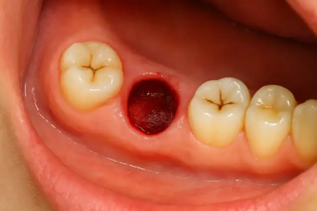 Włóknik po wyrwaniu zęba wygląda jak ciemnoczerwone, wilgotne zagłębienie w dziąśle, otoczone zębami.