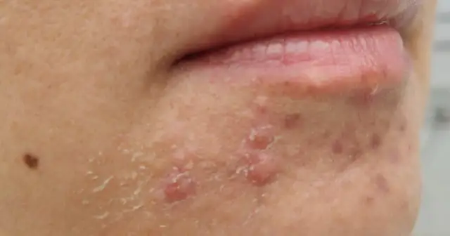 Pryszcze na brodzie: Skuteczne sposoby, przyczyny i leczenie