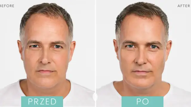 Ile to jest 1 ml kwasu hialuronowego i jak wpływa na efekty zabiegów?