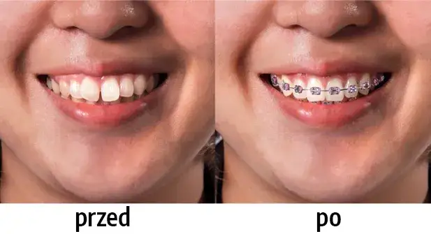 Kiedy założyć aparat na zęby? Wiek, warunki i przeciwwskazania