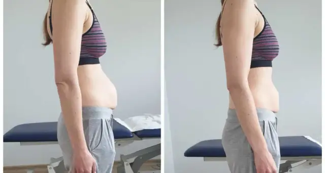 Porównanie brzucha przed i po ćwiczeniach. Jak sprawdzić rozejście mięśnia prostego brzucha?