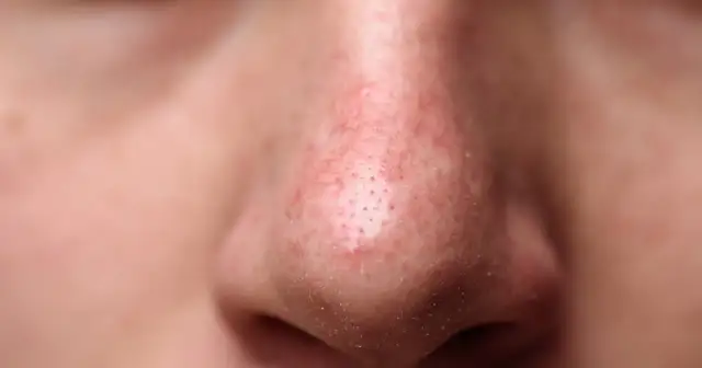 Pryszcze na nosie: Dlaczego powstają i jak się ich skutecznie pozbyć?