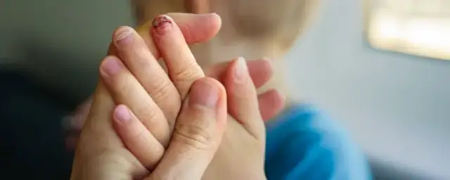 Naderwany paznokieć: szybka pomoc, czego unikać i jak leczyć