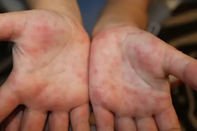 Jakie leki na bostonkę pomogą złagodzić objawy u dzieci?