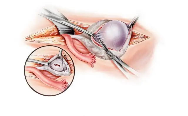 Chirurgiczne usuwanie torbieli na jajniku. Widok powiększony pokazuje szycie po zabiegu.
