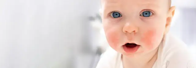 Czy burak uczula? Objawy alergii i co warto wiedzieć o ryzyku