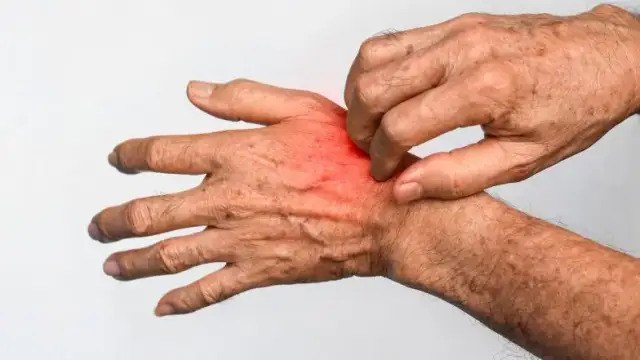 Jakie leki na świerzb bez recepty skutecznie łagodzą objawy?