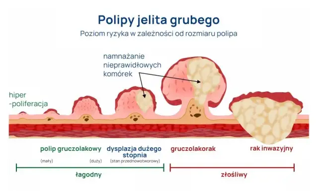 Rak jelita grubego: Czy badanie krwi wystarczy do diagnozy?