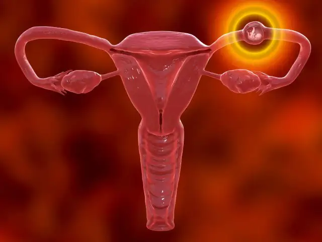 Ciąża pozamaciczna: objawy, które ratują życie. Działaj!