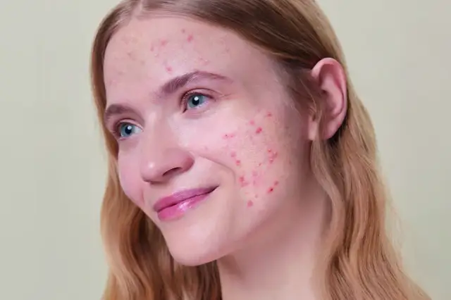 Czym wybielić czerwone plamy po pryszczach? Skuteczne metody i składniki
