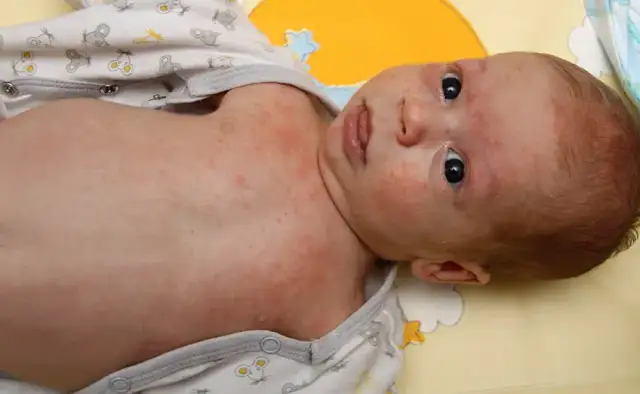 Jak leczyć rumień u dziecka - skuteczne metody i porady dla rodziców