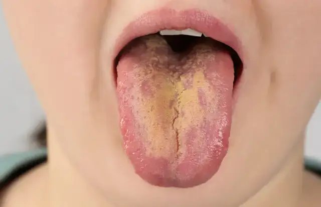 Gronkowiec w jamie ustnej: objawy, przyczyny i kiedy iść do lekarza