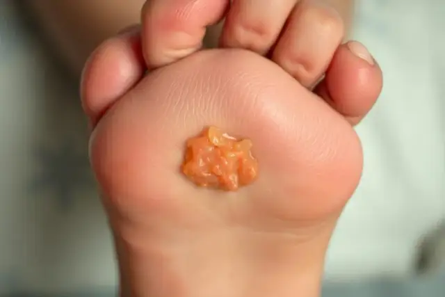 Skuteczne sposoby na odciski u dziecka, które przynoszą ulgę