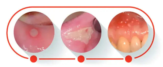 Afta na dziąśle: ile trwa gojenie? Skuteczne leczenie i ulga