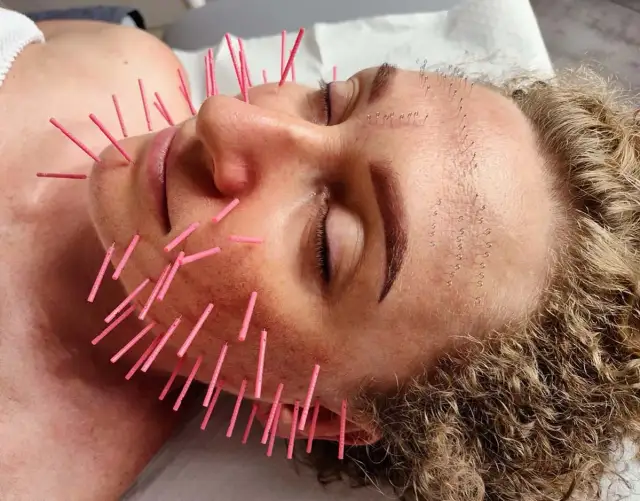 Akupunktura twarzy: Ile kosztuje naturalny lifting? Cennik i efekty