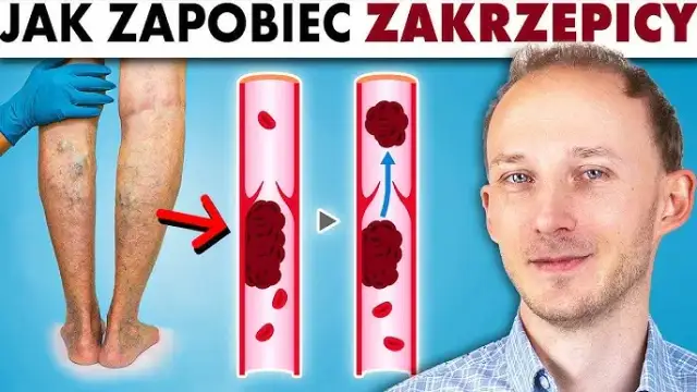 Zakrzepica jaki lekarz: jak uniknąć błędnych decyzji medycznych