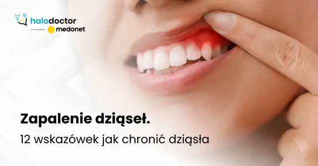 Zapalenie dziąseł: co robić, by uratować dziąsła i zęby? Poradnik.