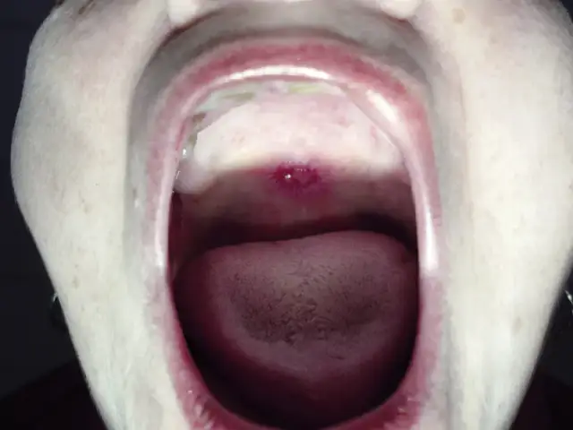 Objawy kiły w jamie ustnej: jak je rozpoznać i uniknąć powikłań