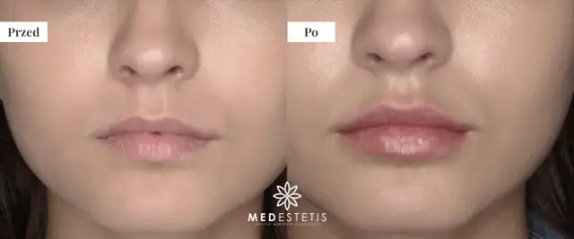 Powiększanie ust: Ile trwa zabieg, gojenie i trwałość efektów?