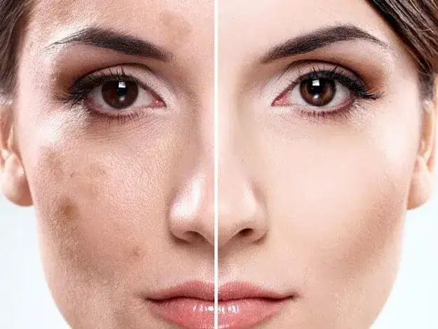 Słońce po depilacji laserowej? Poznaj zasady i uniknij przebarwień