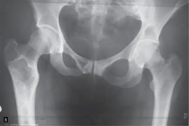 Czym jest ognisko osteolityczne? Przyczyny, objawy i diagnostyka zmian w kościach