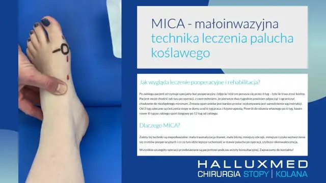 Jak zrobić opatrunek po operacji haluksa - uniknij błędów i bólu