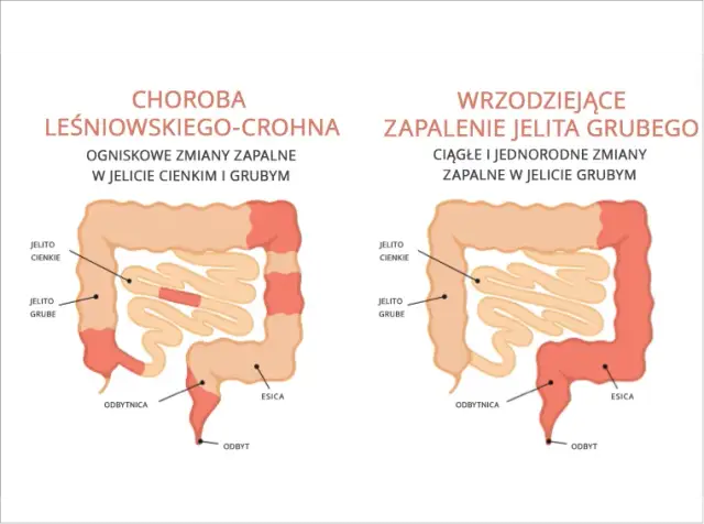 Choroby autoimmunologiczne jelit: 5 głównych przyczyn i terapii