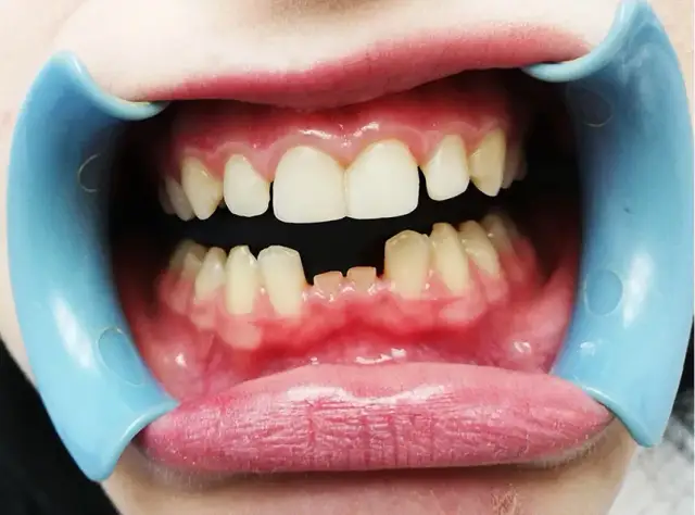 Brak zawiązków zębów: co robić? Kompletny przewodnik dla rodziców