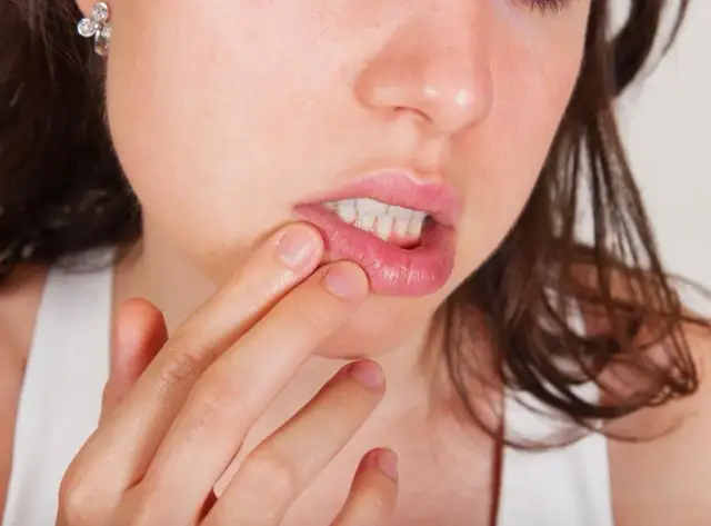 Jak szybko złagodzić oparzenia jamy ustnej? Skuteczne sposoby i porady