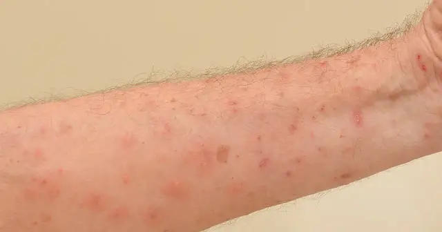 Świerzb: leki bez recepty, jak stosować i kiedy iść do lekarza