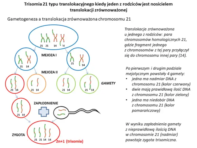 Zespół Downa: objawy, diagnoza i życie z trisomią 21