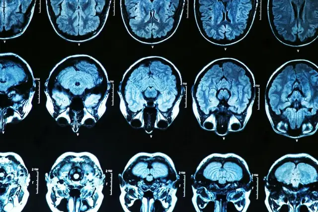 Parkinson: Psychiczne aspekty zrozum, lecz, żyj lepiej