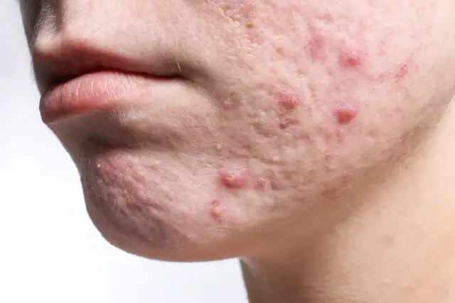 Unreine Männerhaut? So besiegen Sie Pickel & Akne dauerhaft!