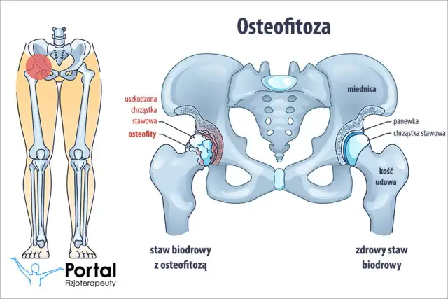 Osteofitoza: Jaka rehabilitacja? Odzyskaj sprawność i zwalcz ból!