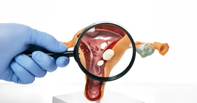 Alkohol po usunięciu polipa macicy: kiedy można bezpiecznie wrócić do picia