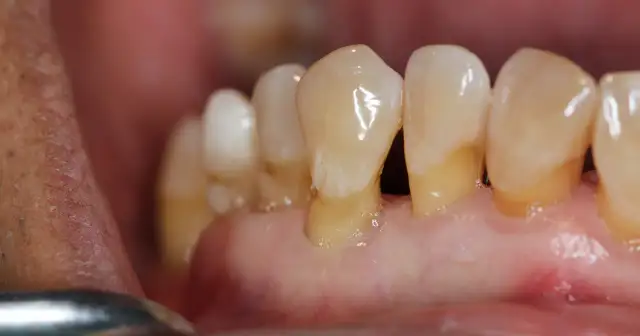 Dlaczego dziąsła się cofają? Poznaj przyczyny i skutki recesji