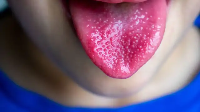 Intensywnie czerwony język z widocznymi, licznymi grudkami na powierzchni.