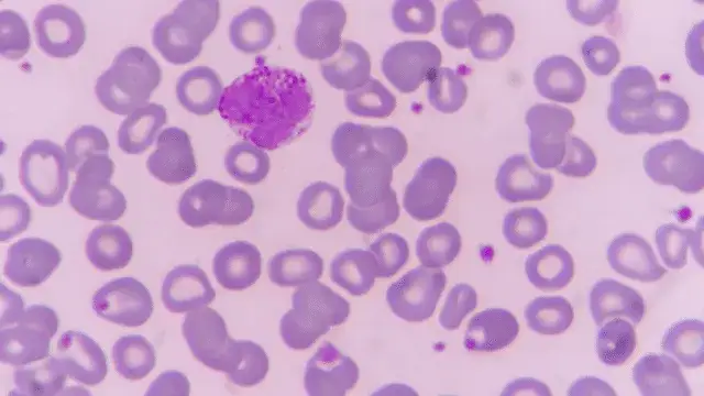 Niedobór bazofili: Jak leczyć przyczynę, nie objaw?