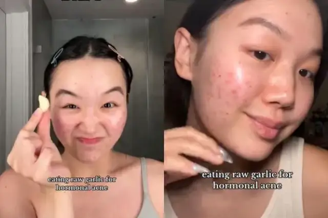 Skuteczne metody na pryszcze - co naprawdę pomaga w walce z trądzikiem