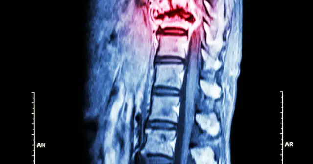 Czy to przerzuty do kości? Objawy i wczesna diagnoza