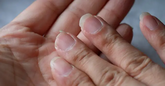 Kruche paznokcie, łuszcząca się skóra – to mogą być objawy niedoczynności tarczycy. Dłonie pokazują oznaki problemów.