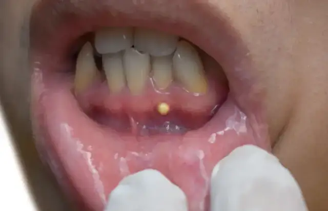 Ropień dziąsła: leczenie, objawy i domowe sposoby na ulgę