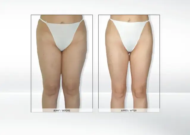 Endermologia: Co to jest? Skuteczny zabieg na cellulit i sylwetkę