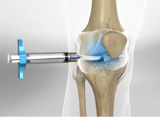 Ile kosztuje zastrzyk z kwasu hialuronowego w kolano? Ceny w 2023